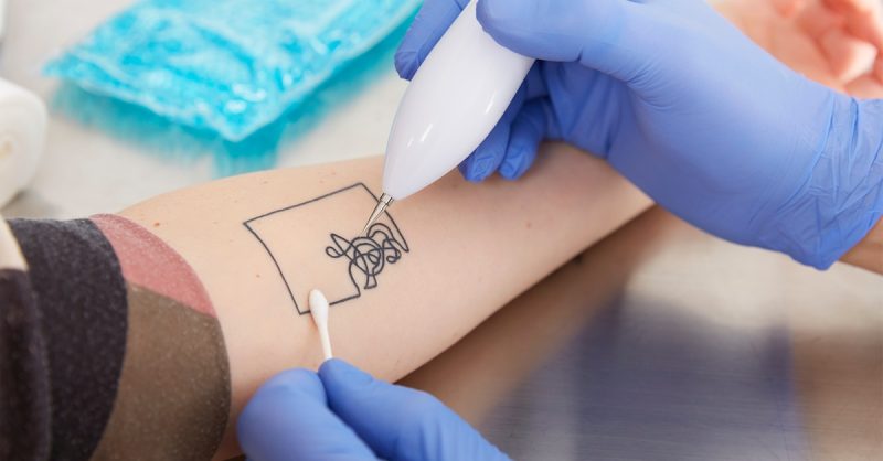 3 Sessions of Laser Tattoo Removal at The Beauty Hub