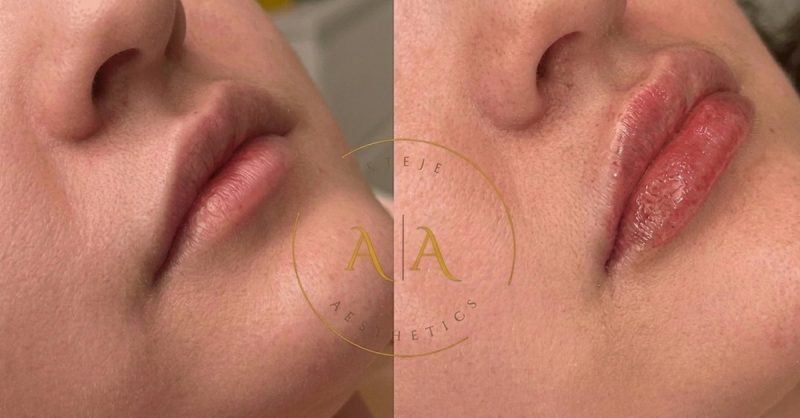 Lip Dermal Filler Treatment at Areje Aesthetics