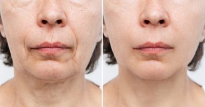 Revitalizing HIFU Facial at SHAZ