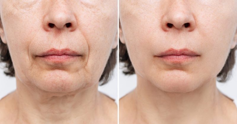 Revitalizing HIFU Facial at SHAZ