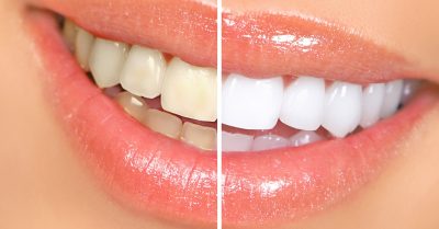 Traditional Teeth Whitening at Tomas Clinic
