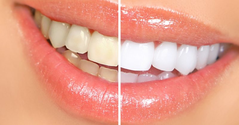 Traditional Teeth Whitening at Tomas Clinic