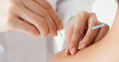 40-Minute Acupuncture with Consultation at Lotus TCM