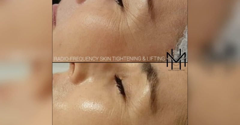 Non-Surgical Face Lifting at London PMU MastersHands