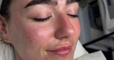 Polynucleotide HA Microneedling Treatment at Zena Aesthetics