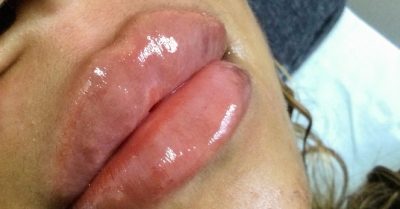 Dermal Filler for Lips, Cheeks, Chin at Fabuluxe Aesthetics