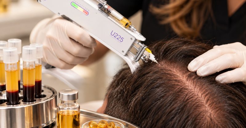 Scalp Revitalization with Micro-Needling at YourHealthFirst