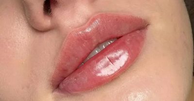 Enhance Your Beauty with Dermal Filler at Aesthetic Zone