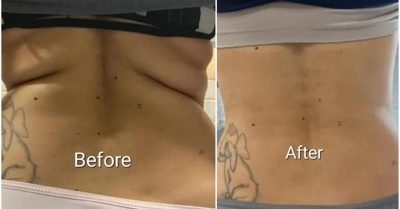 Fat and Cellulite Reduction Treatment at Noire Aesthetics