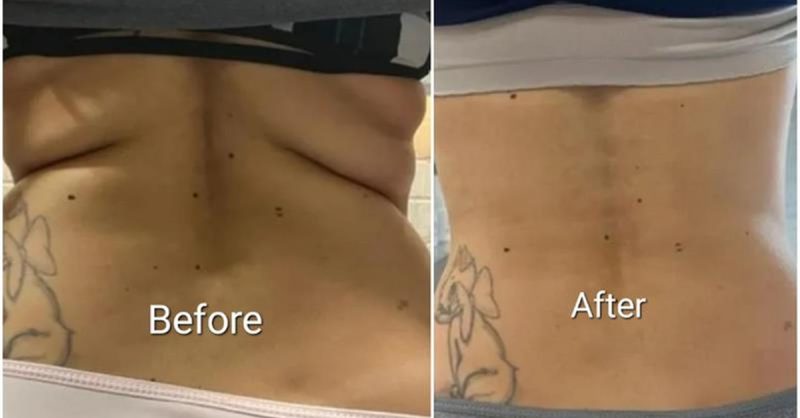 Fat and Cellulite Reduction Treatment at Noire Aesthetics