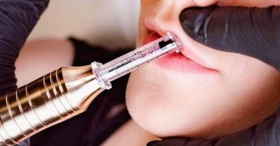 Hyaluron Pen Filler Treatment at London Body Clinic