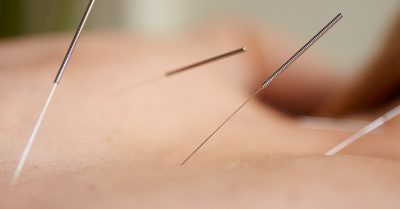 Acupuncture or Cupping Treatments at London Health and Wellbeing