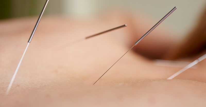 Acupuncture or Cupping Treatments at London Health and Wellbeing