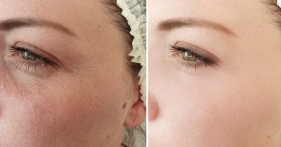 Aqualyx Fat-Dissolving Treatment at Glam Aesthetics Group