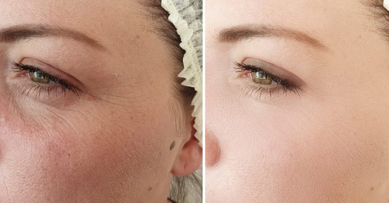 Aqualyx Fat-Dissolving Treatment at Glam Aesthetics Group