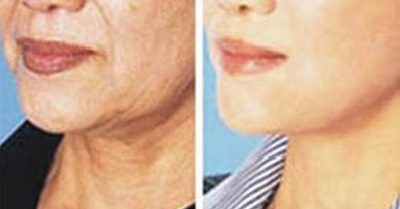 Revitalize Your Skin with a Facial at Keco Health