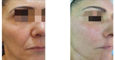 Radio Frequency Skin Tightening at Zena Aesthetics