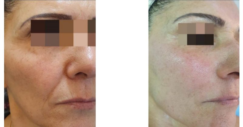 Radio Frequency Skin Tightening at Zena Aesthetics