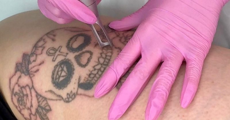 Tattoo Removal at HL Lasers in Your City