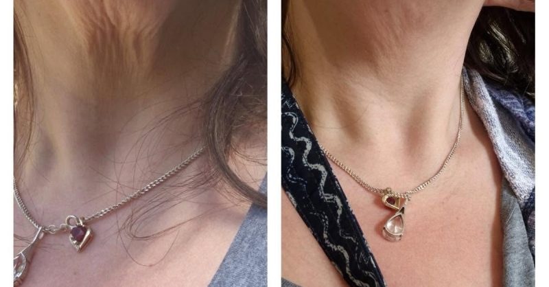 HIFU Face & Neck Treatment at My choice aesthetics
