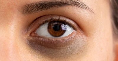 Revitalize Your Eyes with Dark Circle Treatment at Regains Beauty & Aesthetics