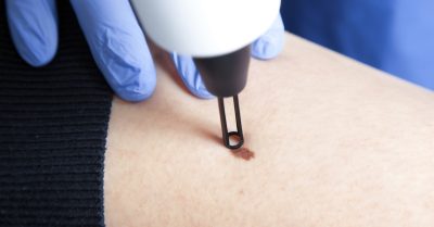 Lesion Removal Sessions at Bioskin Beauty place
