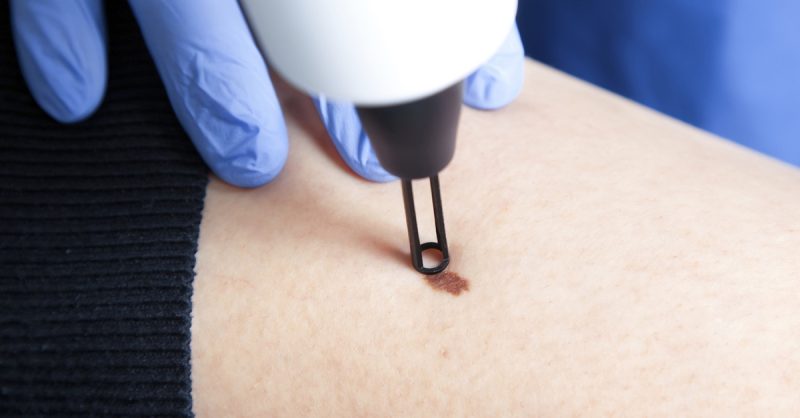 Lesion Removal Sessions at Bioskin Beauty place