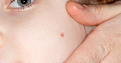 Advanced Electrocautery for Skin Tag & Wart Removal at Derma Skinology
