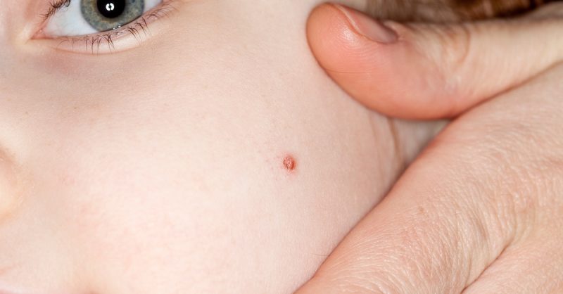 Advanced Electrocautery for Skin Tag & Wart Removal at Derma Skinology