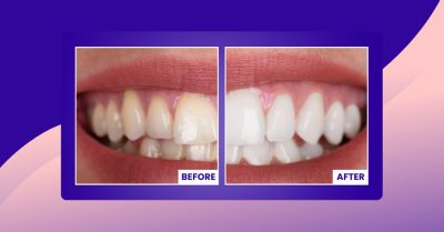 Professional Teeth Whitening Treatment at StarSmiles