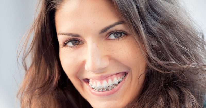 Braces, Retainers & Whitening at iDental