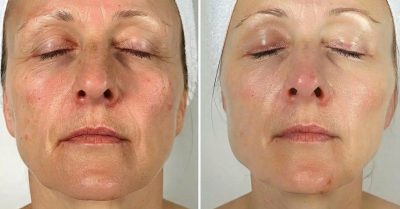 Polynucleotide Skin Treatment at Glow By Jade Aesthetics