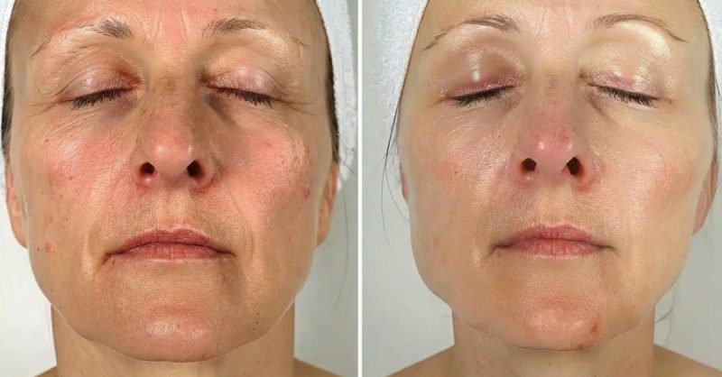 Polynucleotide Skin Treatment at Glow By Jade Aesthetics