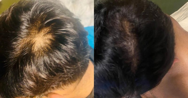 PRP Hair Regrowth and Face Treatment at Regains Beauty & Aesthetics