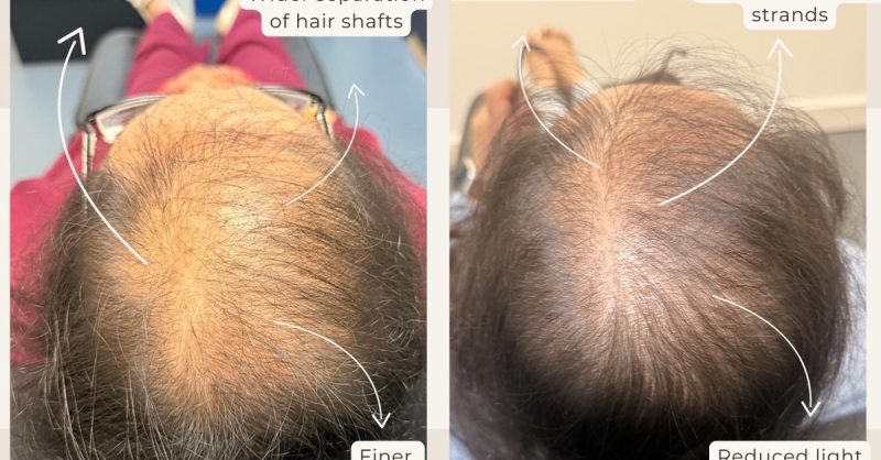 Revitalize with AesthetiSKN's PRP Treatment for Hair or Face