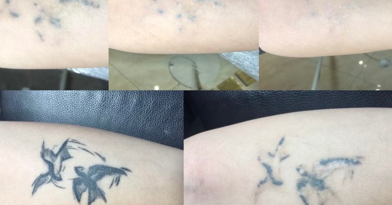 Pico Laser Tattoo Removal at bc clinic