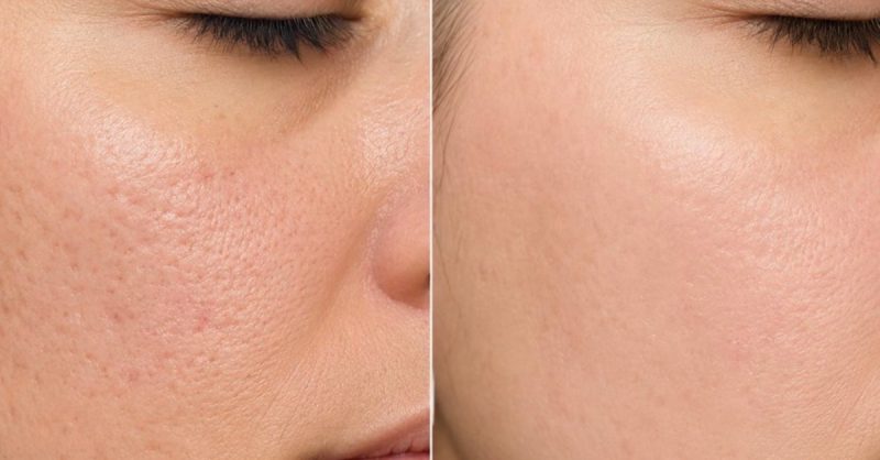 Microneedling with Advanced Salmon DNA at The glow studio