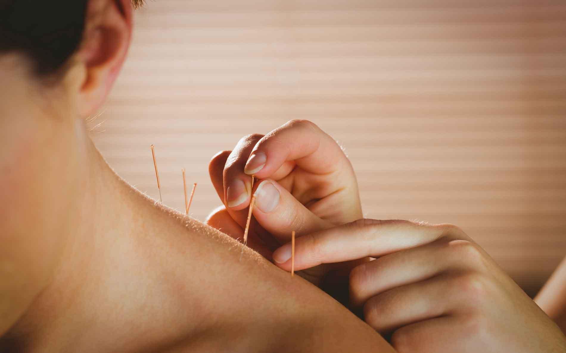 Akupunktur eller cupping