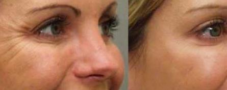 Botox behandling hos Klinik Mind Body and Soul i København Ø