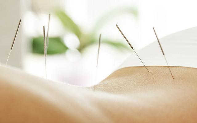  60 minutters akupunktur & cupping