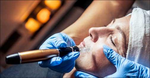 Microneedling behandling hos Salon Auralilja - Få flot hud
